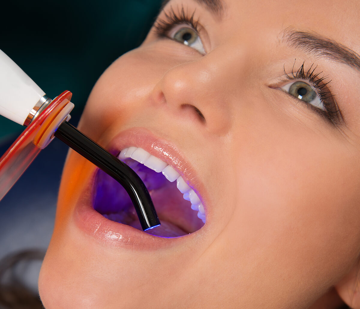 Laser Dentistry Services in Lauderdale FL Area